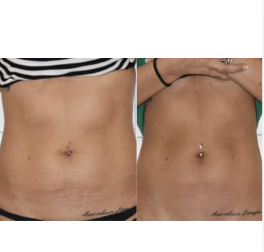 Customer six-week before and after with the Exoh red light therapy belt